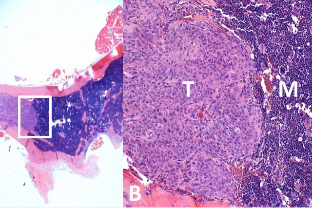 adenocarcinoma metastásico cáncer de próstata adenocarcinoma metastásico cáncer de próstata